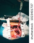 Small photo of Close up of open heart surgery cardiopulmonary bypass, minimal invasive cardiac surgery, cannulation techniques. Minimally invasive mitral surgery through mini-thoracotomy with cannula