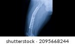 Small photo of A hip and thigh x-ray showing closed fracture at shaft of right femur. The patient has fixation with plate and screws