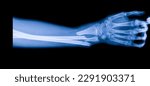Forearm x ray after car...
