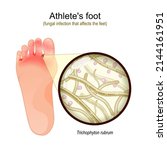 Athlete's Foot Is A Fungal...