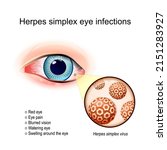 herpes simplex eye infections.... | Shutterstock .eps vector #2151283927