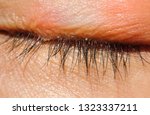 Small photo of close up Blepharitis or Eyelid inflammation eyes healthy concept