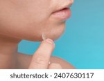 Small photo of Girl with acne stick round acne patch on her cheek. Using acne patches for treatment of pimple and rosacea close-up. Facial rejuvenation cleansing cosmetology