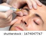 Close up macro detail of middle aged man having skin tightening on eyelids with laser plasma pen.