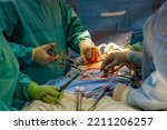 Small photo of Procedure of coronary artery bypass graft CABG for the operation a heart due to coronary heart disease in an operating room in hospital