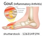 Gout  Inflammatory Arthritis ...