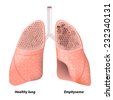Emphysema. Chronic Obstructive Pulmonary Disease. Diagram Showing A ...